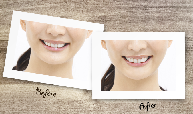 目立たない矯正3種