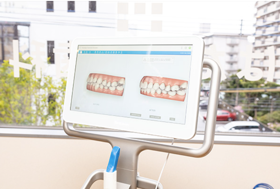 iTero（アイテロ：光学3Dカメラ）