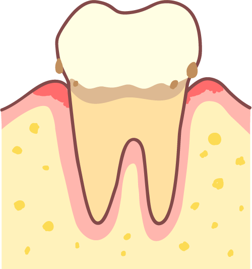 予防と早期の治療が大切です