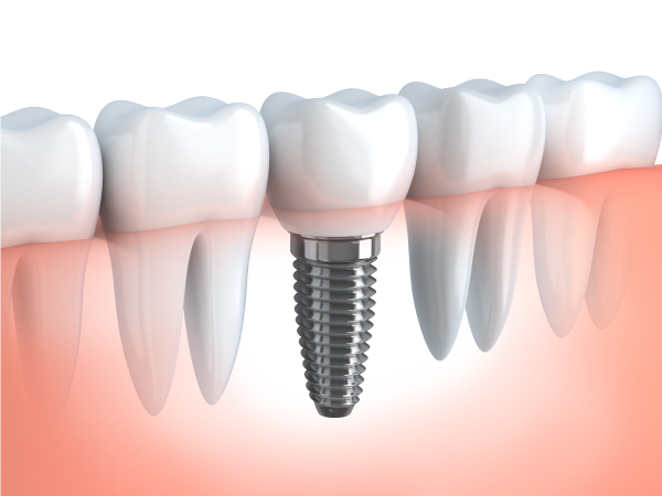 失った歯の機能をしっかり回復