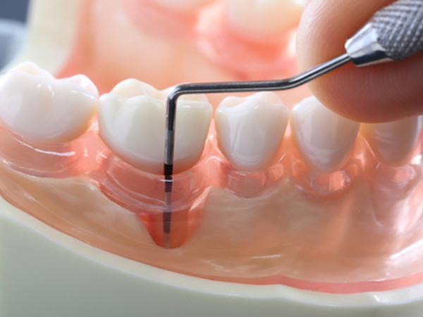 治療法を適切に組み合わせ、歯周病の改善を目指します