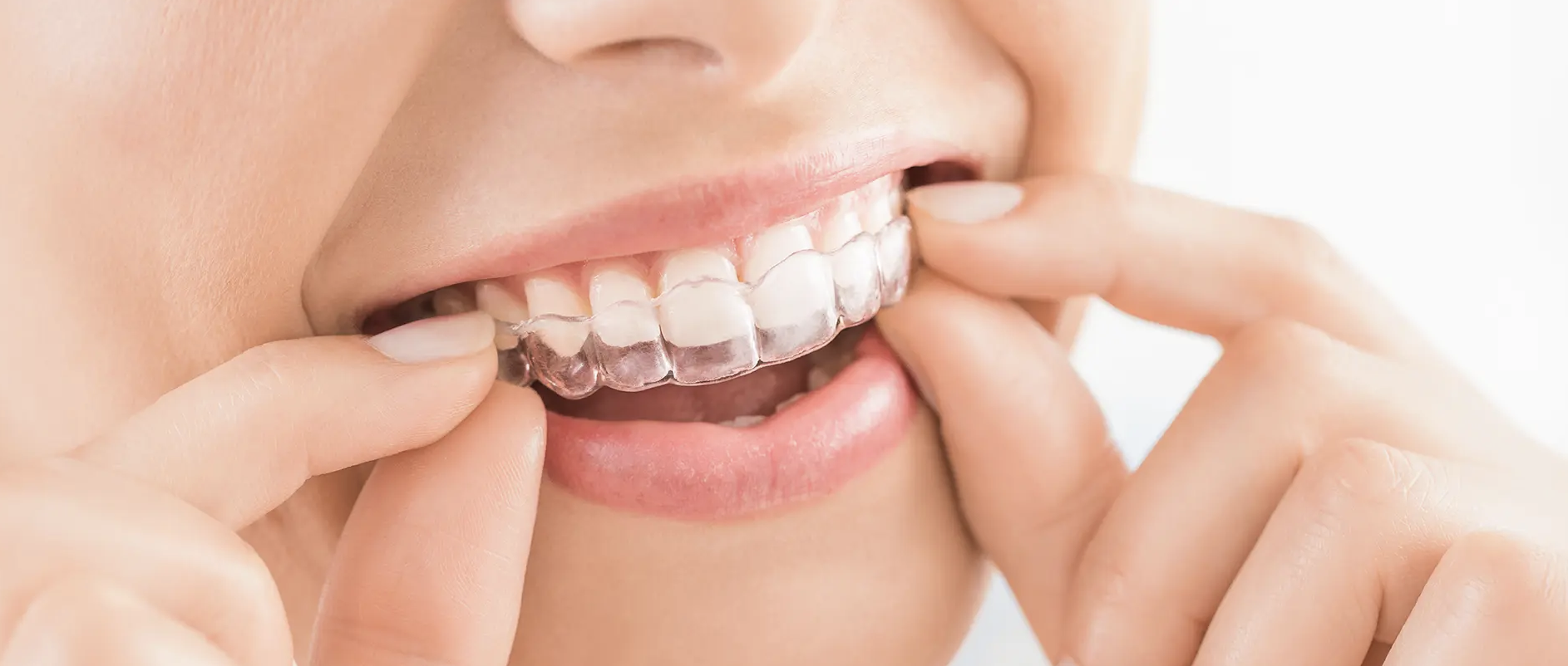 マウスピース型矯正装置（インビザライン）を中心に治療を行っています