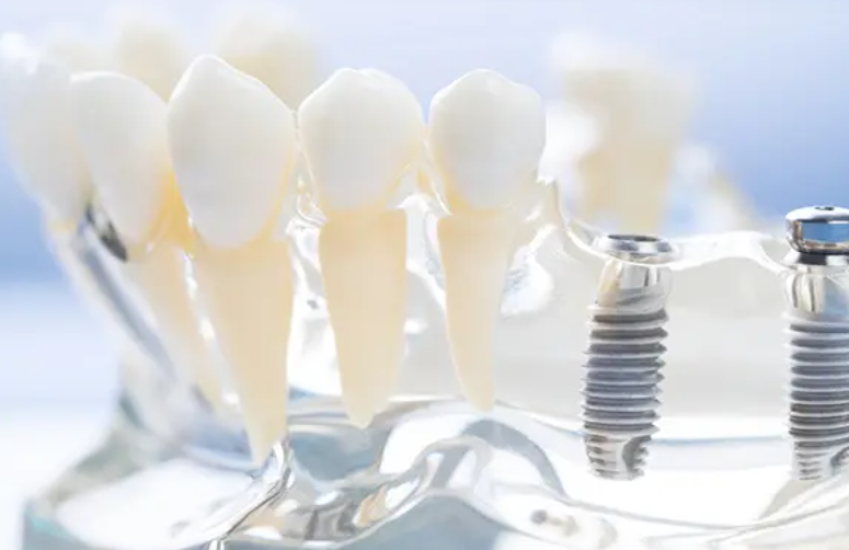 豊富な症例数に基づく確かな技術で自然な噛み心地を実現するインプラント治療