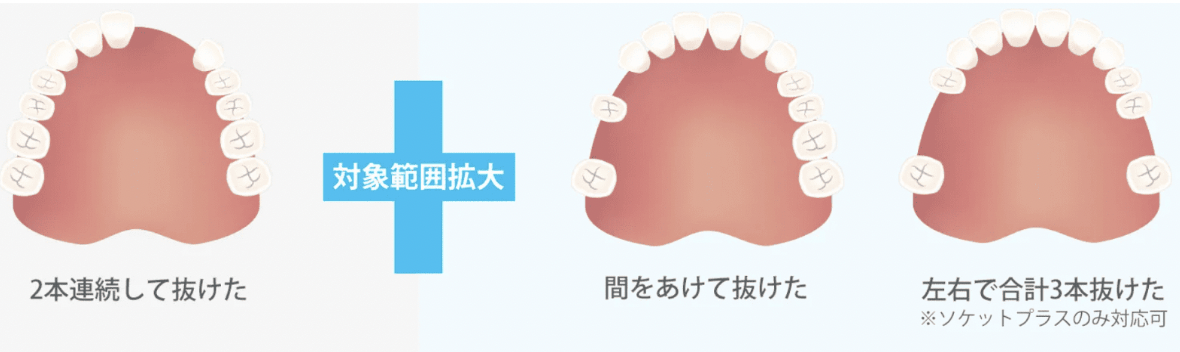 歯茎に密着して外れにくく、噛み合わせの痛みを和らげるコンフォート義歯