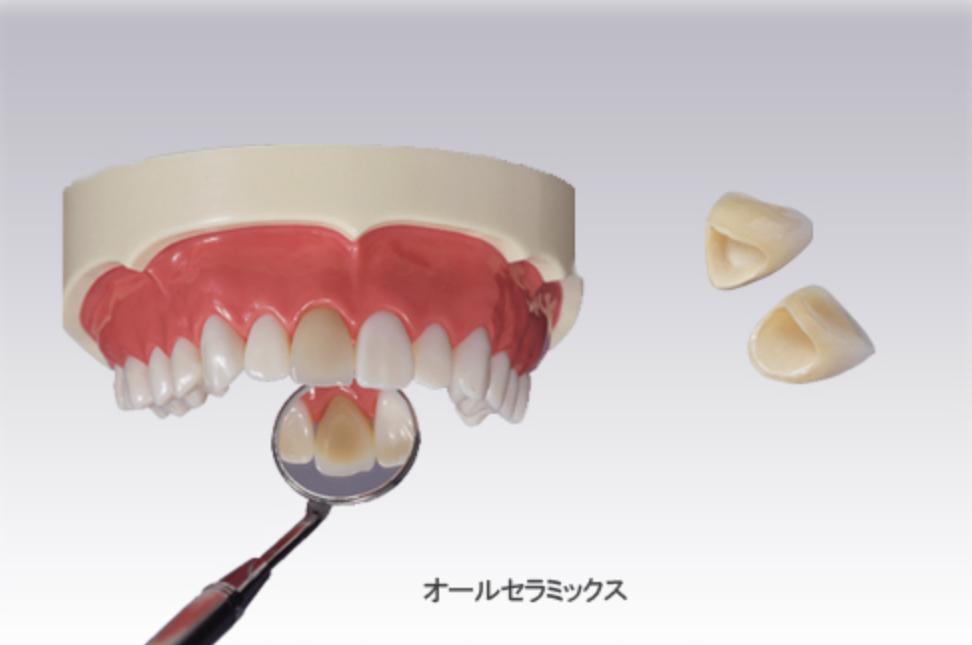 オールセラミックス