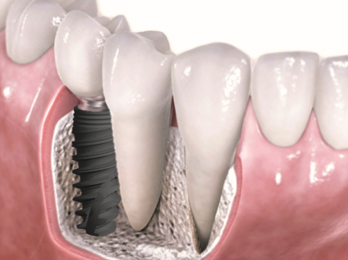 オキナワ・デンタルオフィスにおけるインプラント治療