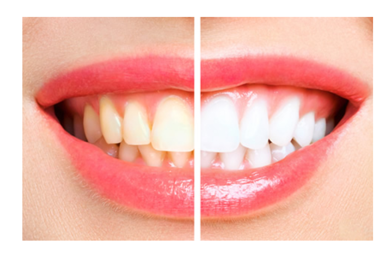 ホワイトニング２種ご用意