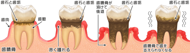 歯周病の進行