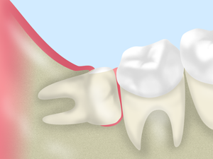 親知らずの痛みや違和感に対して、口腔外科的な視点から適切な診断と処置を実施しています