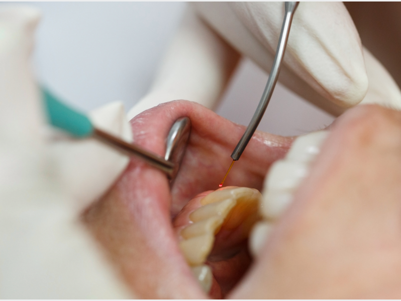 虫歯と口臭の関係