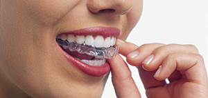 インビザラインは矯正していることに気づかれにくい治療法です。