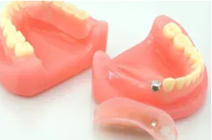 ノンクラスプデンチャー