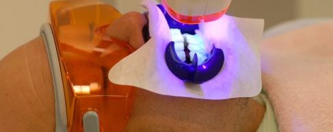 ホワイトニング