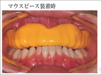 スポーツをする方向けにマウスガード（マウスピース）の製作に対応しています