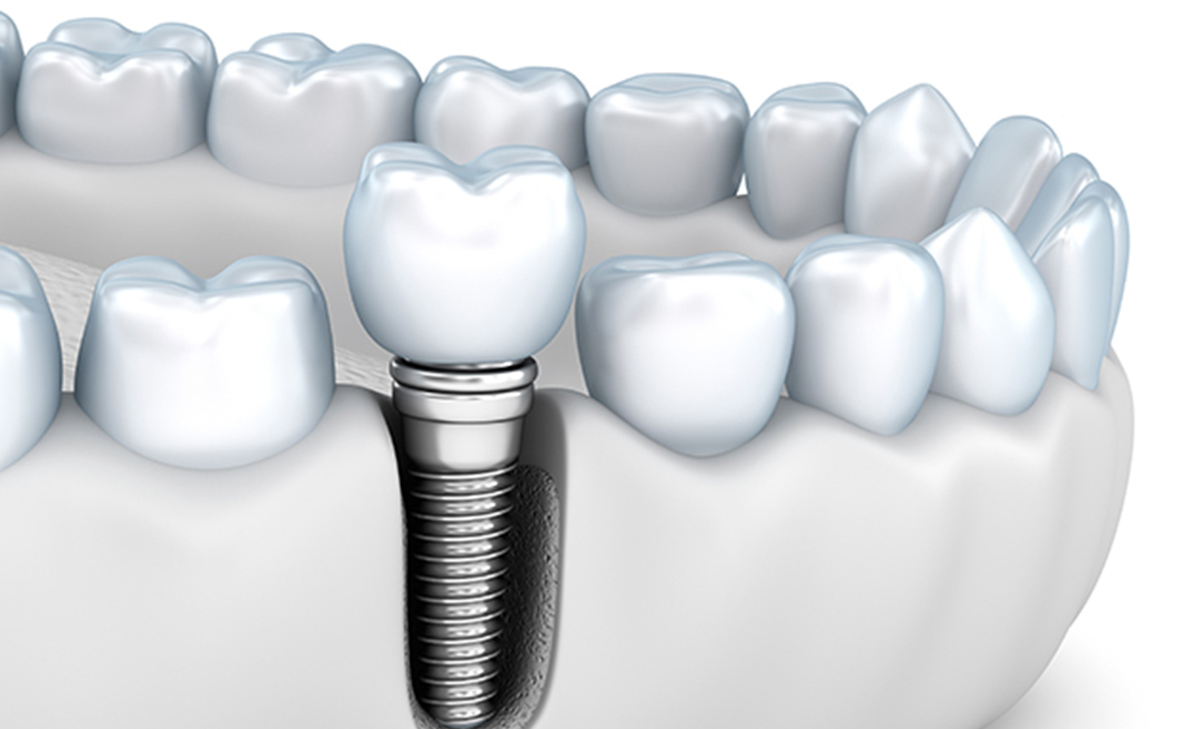 インプラント治療