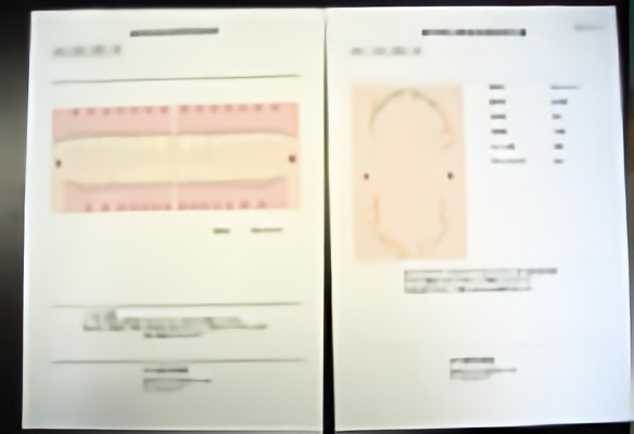 歯周病の検査結果やお口の磨き残し状態などをお渡しします