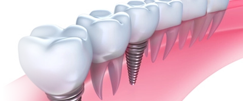 まるで本物の自分の歯のような感覚に
