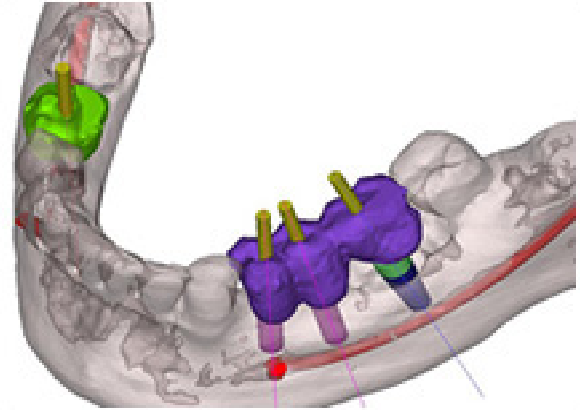 シンプラントという3D画像診断システムにより正確な治療を行います