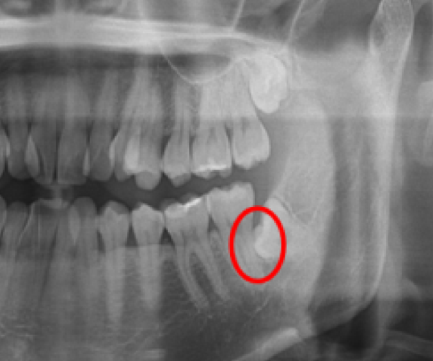 親知らずは横向きに生えると健康な歯に悪影響を及ぼします