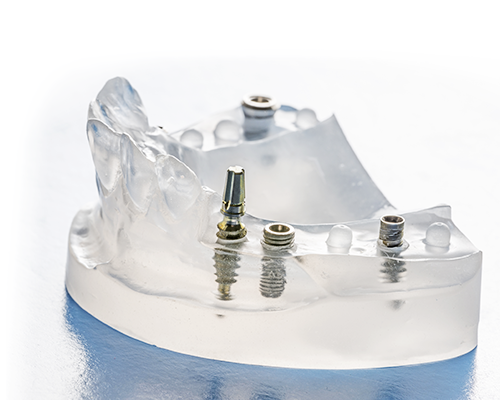 インプラントが長持ちするようアドバイス