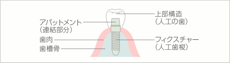 歯科用CTを用いたインプラント治療を行っております