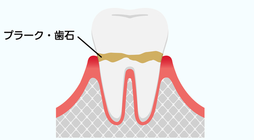 初期段階からの丁寧な予防と管理で進行を防ぐ