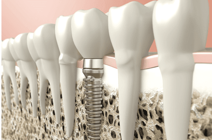患者様の快適な口腔環境をサポートするためにインプラント治療を行っています