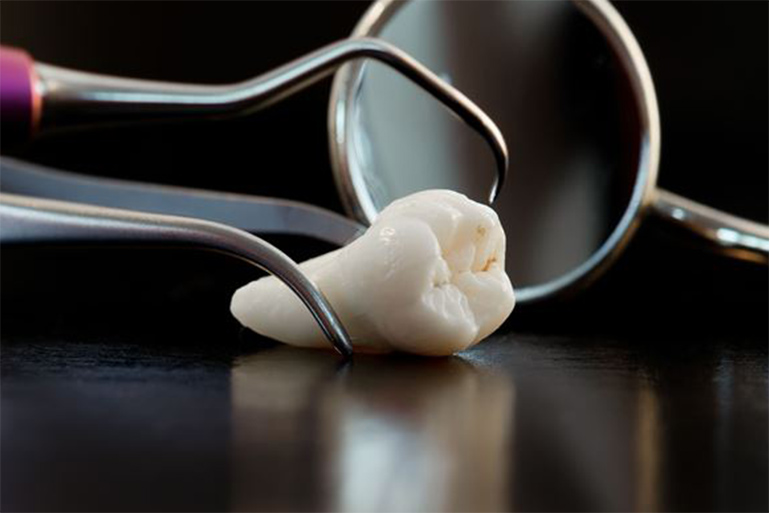 検査が終わると、口腔内の状態や抜歯の方法、手順、術後の注意点などを丁寧に説明し、患者様に理解していただいたうえで治療を進めます