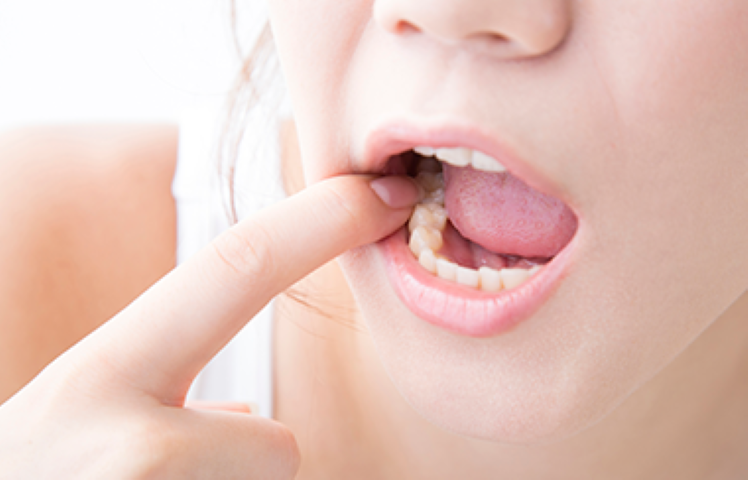 MI（ミニマルインターベンション）を重視するてらだデンタルクリニックの虫歯治療