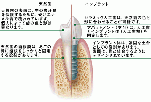 インプラントには多くの利点があります