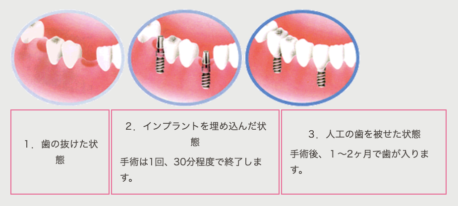 入れ歯やブリッジと比べて違和感が少なく、自分の歯に近い感覚で使用できます