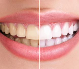 矯正治療と併用で歯をきれいに