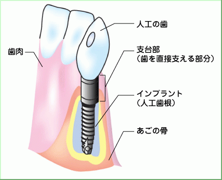 自分の歯のように噛める未来へ―キダ歯科のインプラント治療