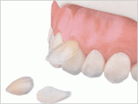 ラミネートべニア治療