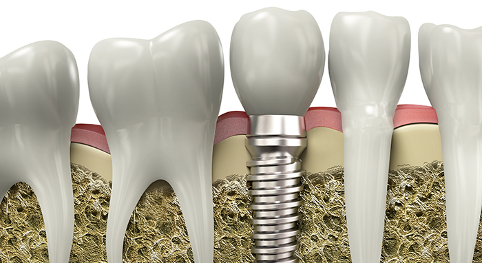 自然な白さと自分の歯に限りなく近い見た目を提供します。