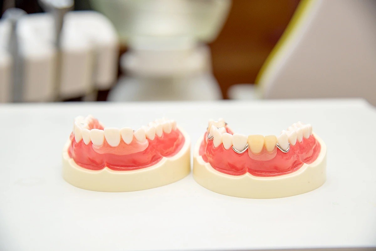 ノンクラスプデンチャー