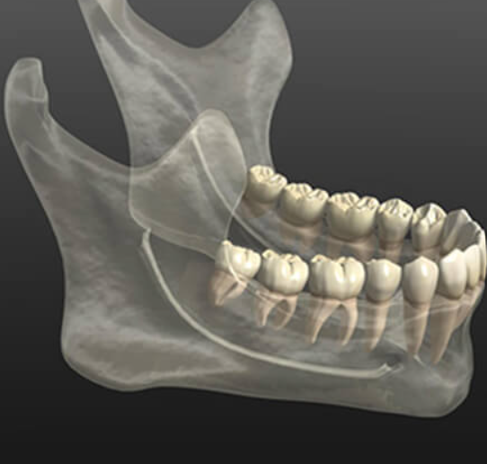 難易度の高いインプラント治療にも対応いたします
