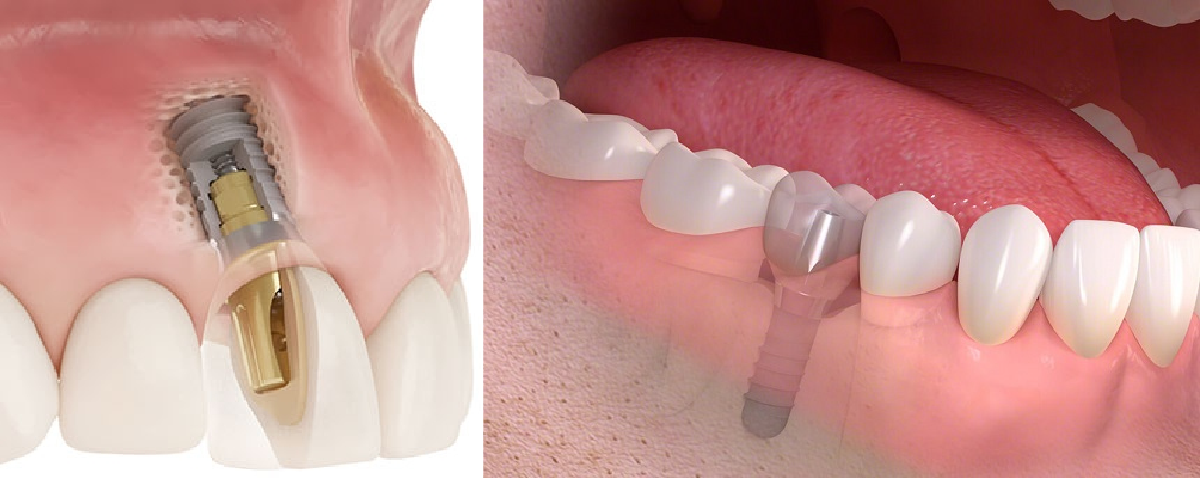 インプラントは顎の骨に固定されるので、しっかりとした嚙み心地を味わうことができます