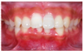 歯を怪我した場合は早めの受診をおすすめします