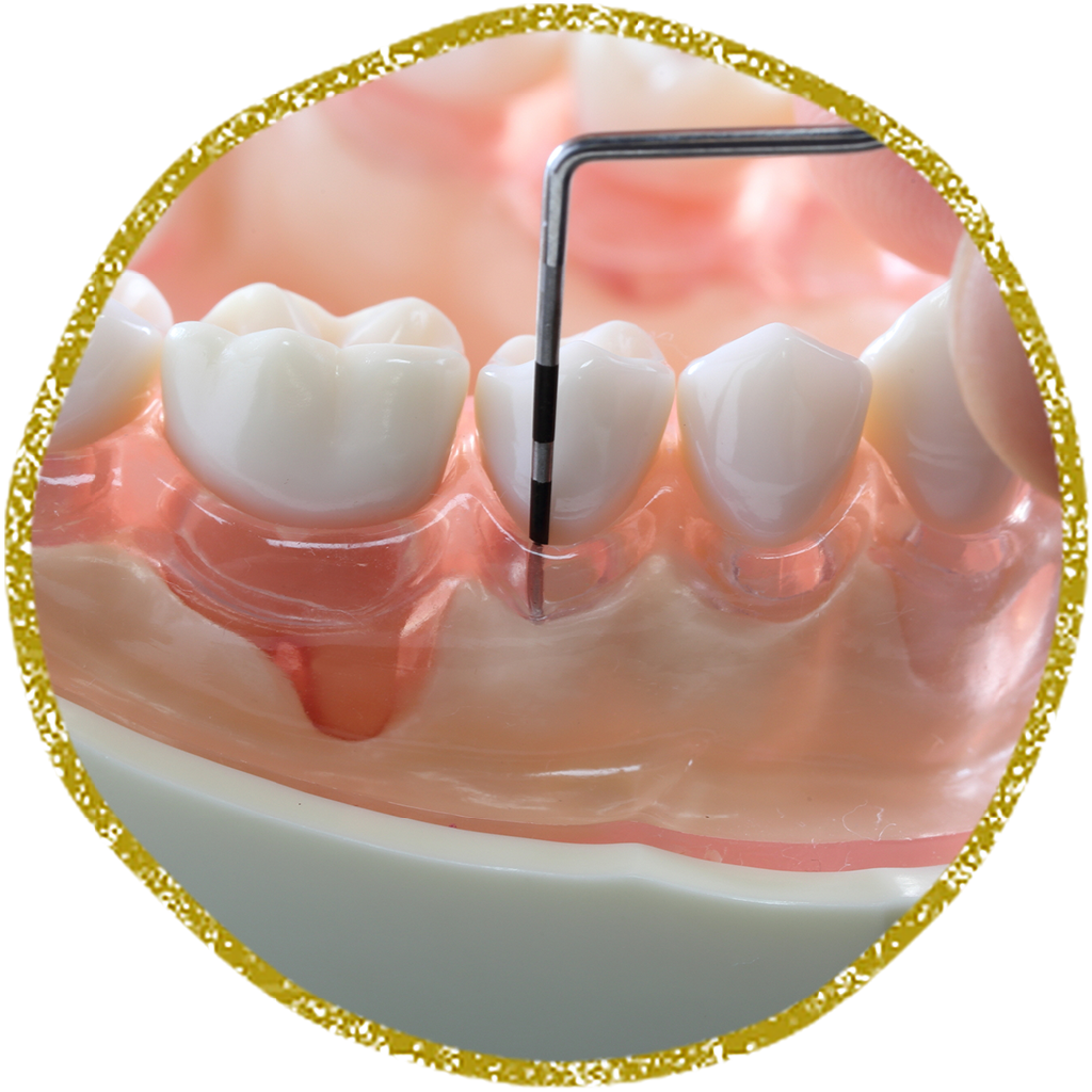 歯周病の早期発見とケアを通じて、歯ぐきや歯を健康に保つ治療が行われています
