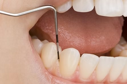 定期メンテナンス時には専用機器を用いた歯周病検査を実施し、お口の状態を詳しく確認しています。