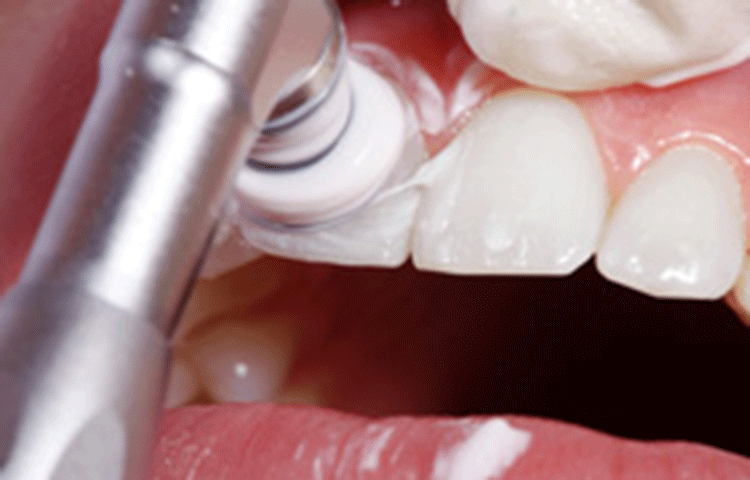 定期的なクリーニングで歯周病になりにくい歯へ