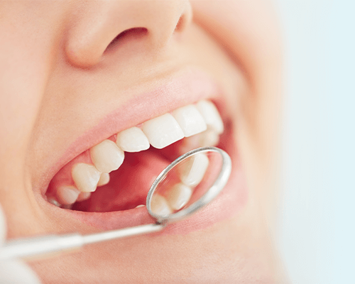 痛みを感じる前に、虫歯治療