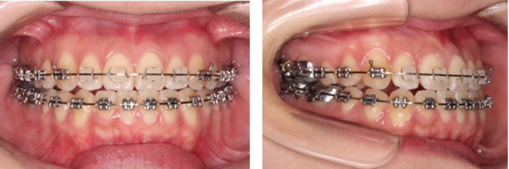 唇側矯正装置（セラミック製）