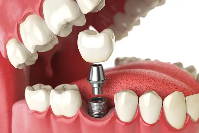 骨と結合するチタン製の人工歯根で、自然な機能と見た目を取り戻します