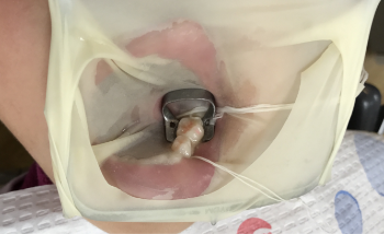 ラバーダムの装着時です