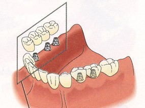 歯を失った場合の治療方法としてインプラント治療に対応しています