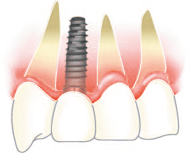 インプラントと天然歯が長期間共存できるように、骨が薄い場合の造骨手術や歯茎が薄く見た目が悪い場合には歯肉移植など、さまざまな治療法を取り入れています。