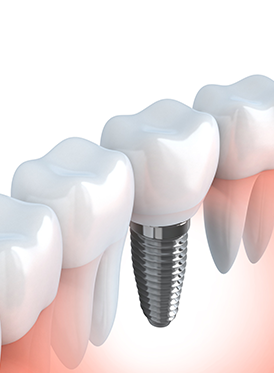 失った歯を自然な噛み心地と見た目で取り戻すための効果的な治療法です。