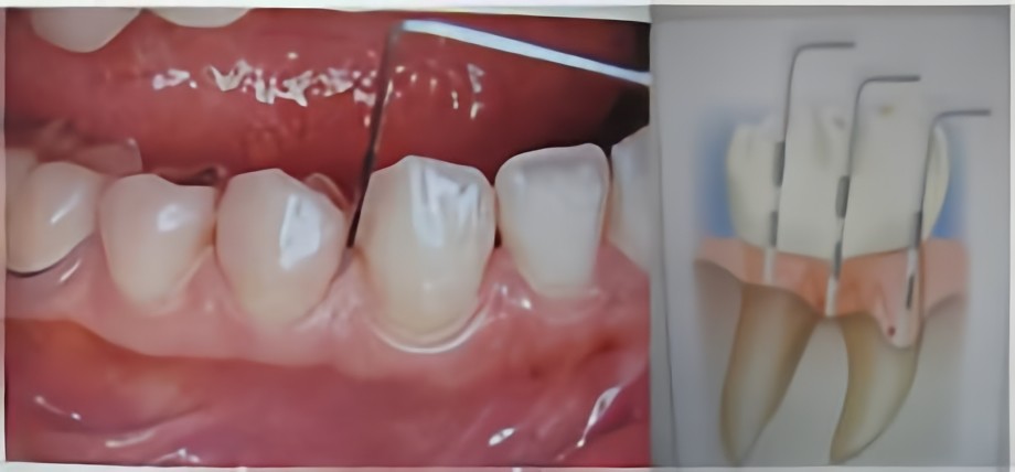 歯周ポケット検査